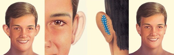 Ear Surgery Medford Ear Surgery Medford